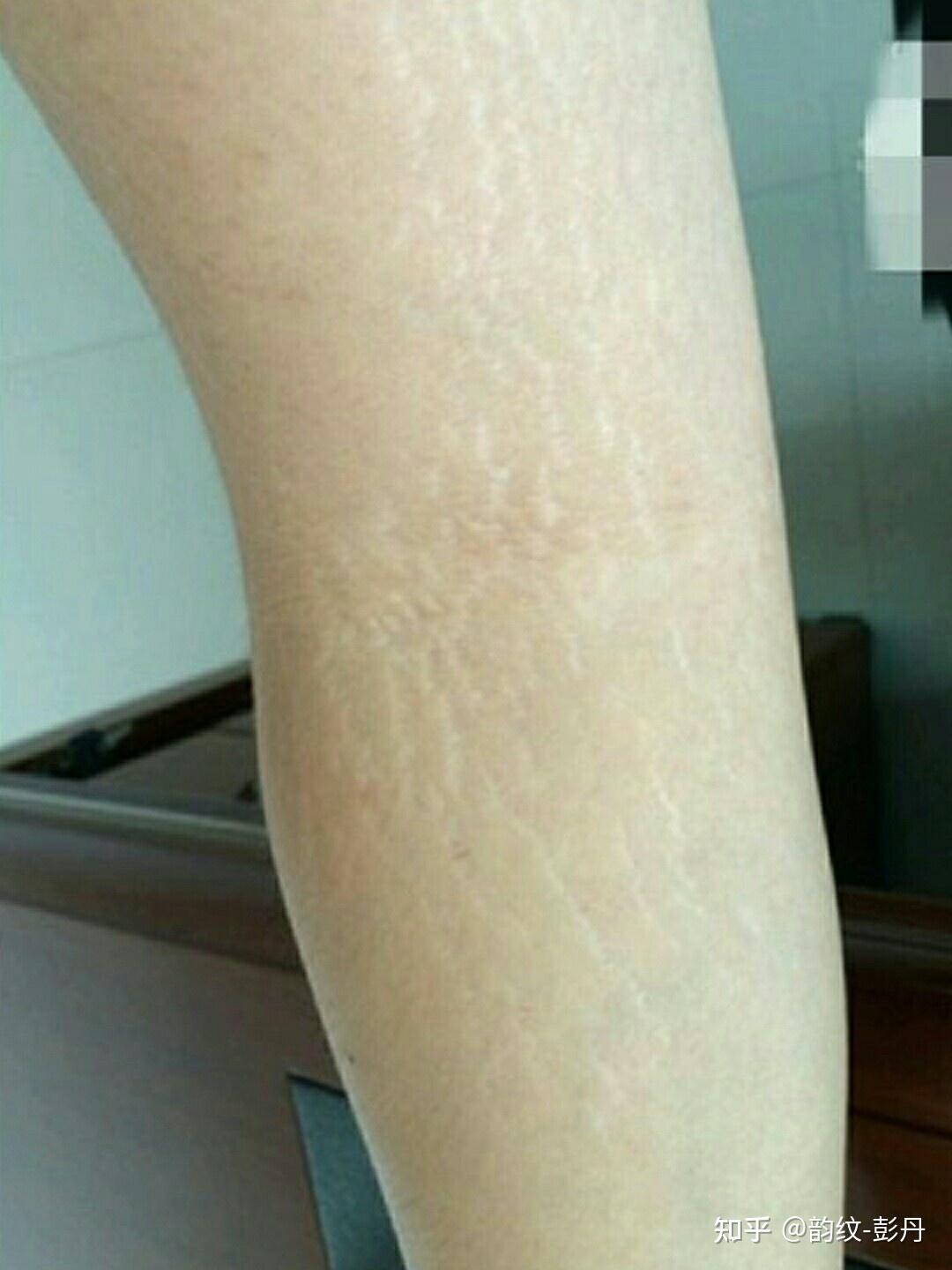 小腿后侧这两天突然长了很多肥胖纹是因为什么? - 知乎