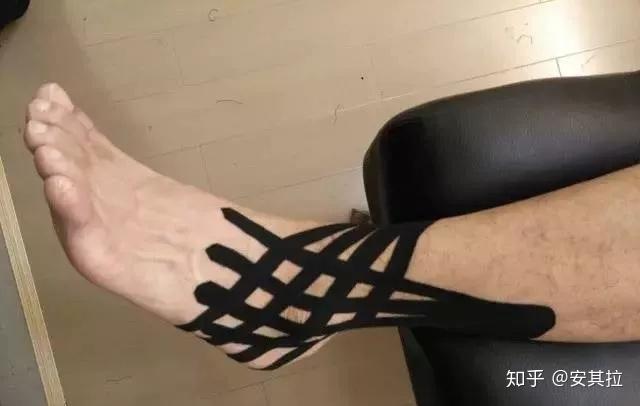 拯救脚踝扭伤的利器肌内效贴