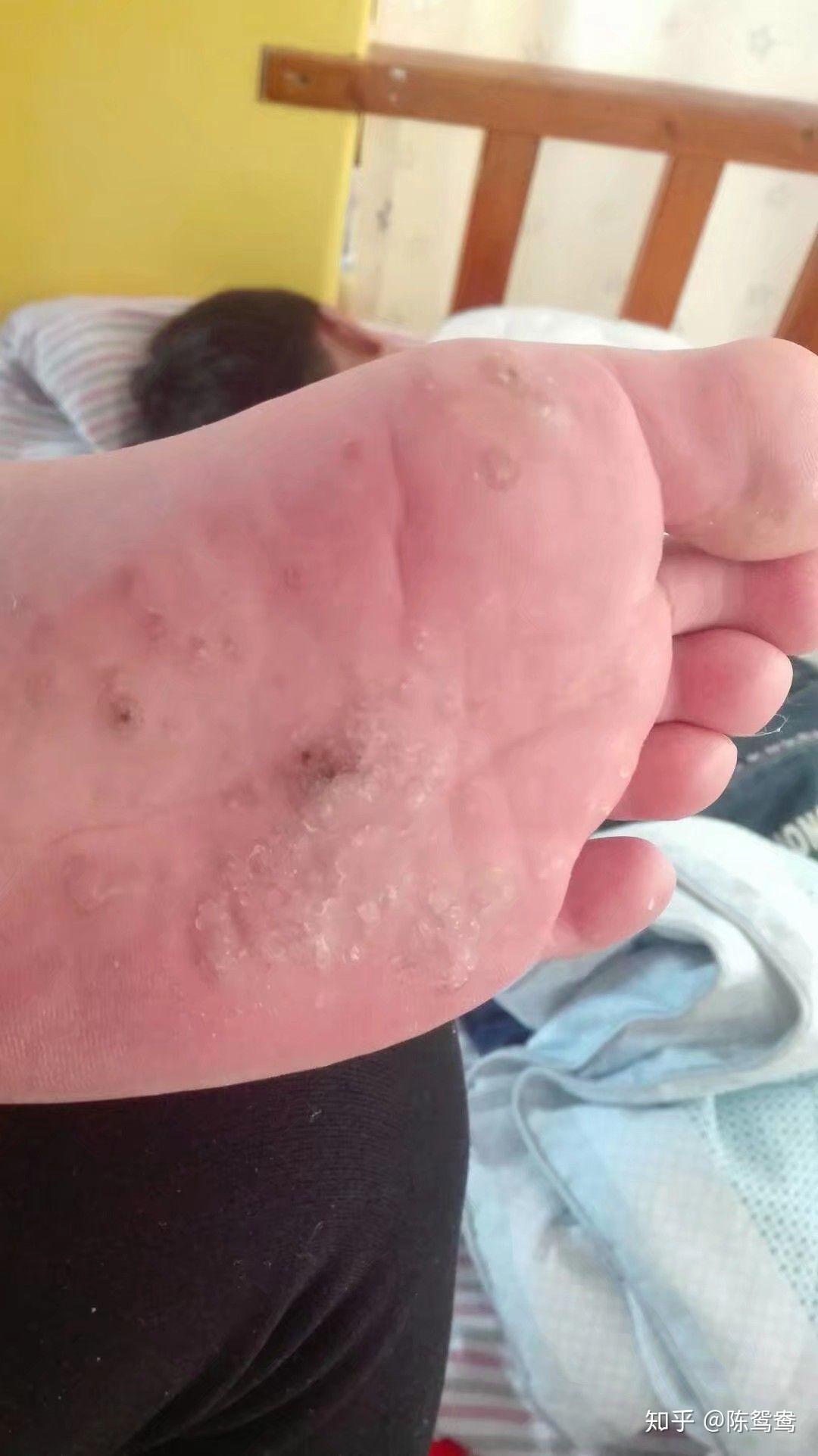 (泡了半小时的鬼样子,非常可恨的厚脚皮,恨不得用指甲剪给他剪深一点)