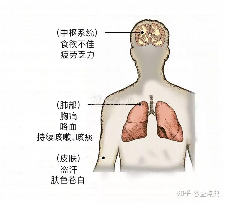 【慢病数据库】肺结核科普 - 知乎