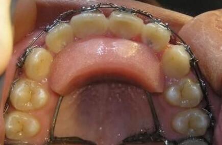 深覆颌,深覆盖矫正 固定平导