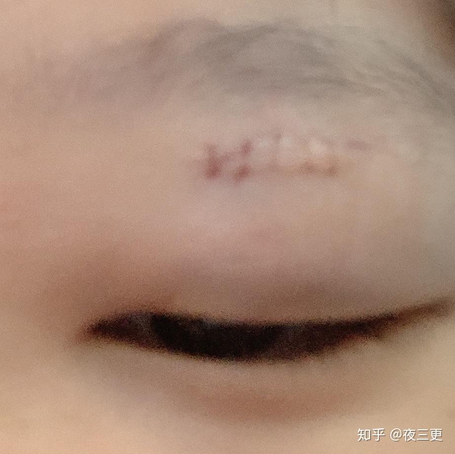 眼皮里长了个类似囊肿的(内充黄色脓),可现在两只眼睛又长了,无疼痛感