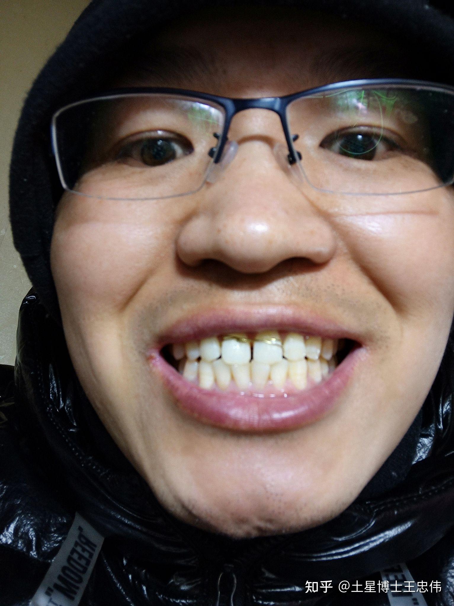 自我修复门牙缝