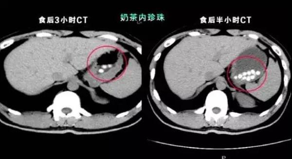 喝完珍珠奶茶照CT真的有阴影,珍珠是塑料做的?