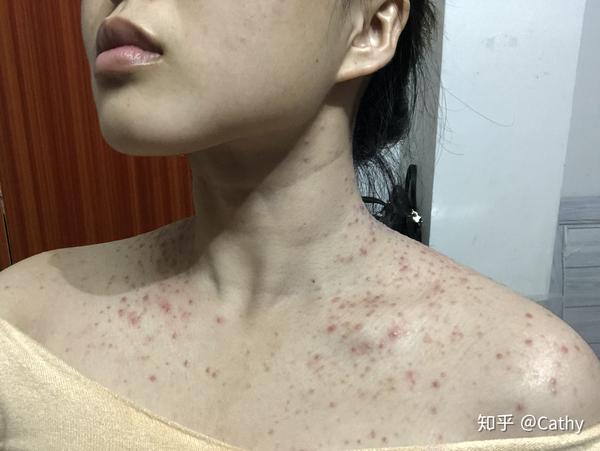 马拉色菌毛囊炎怎么治