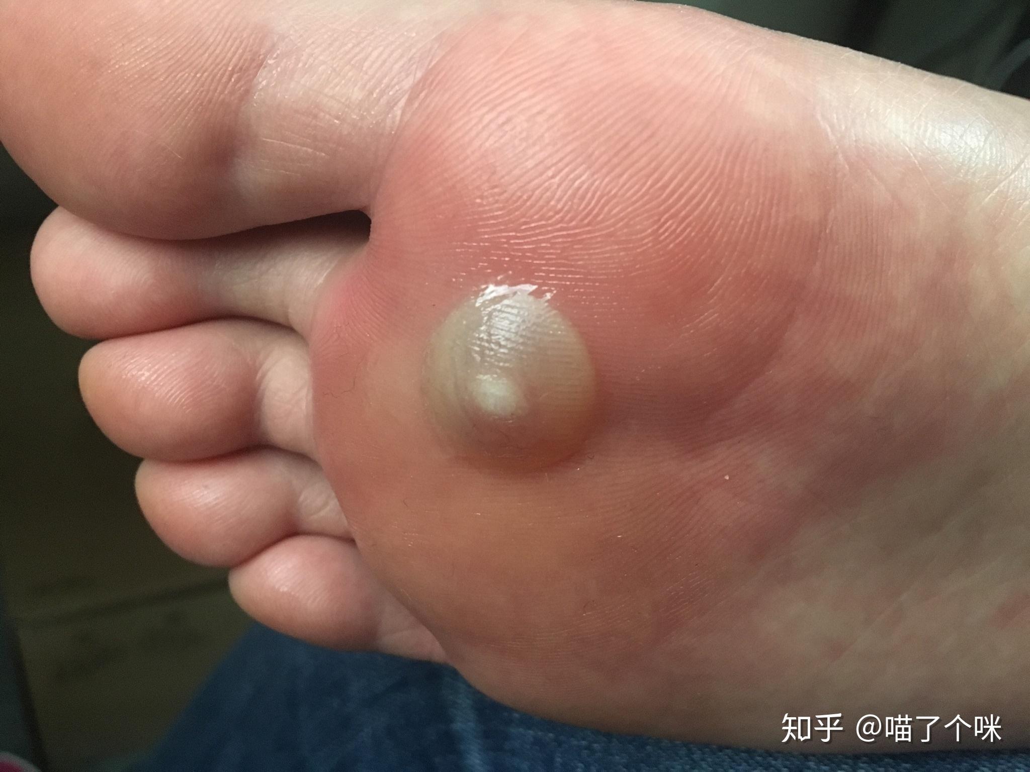 液氮冷冻治疗怎么做? - 知乎