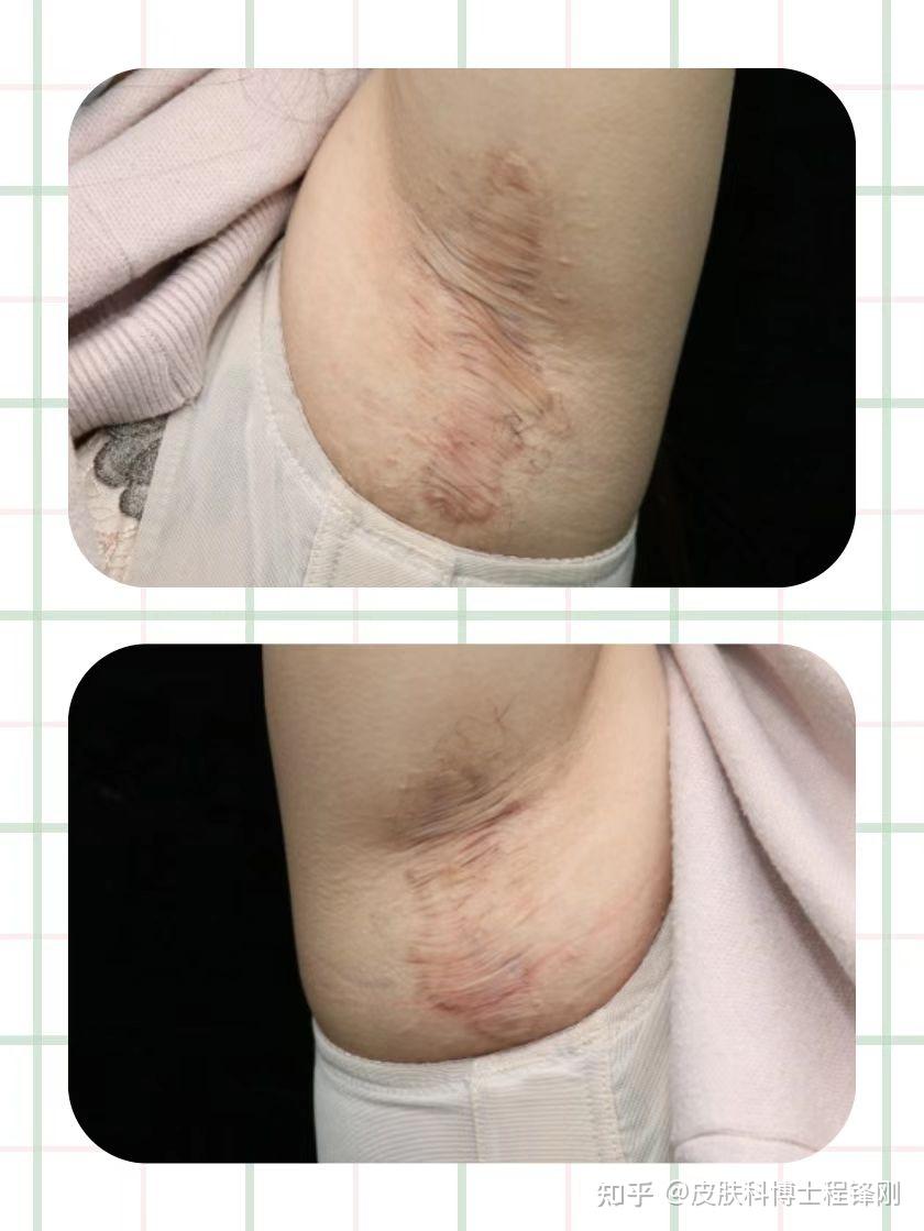 首先要对术后疤痕进行评估,按照疤痕和腋下皮肤状况选择不同的治疗