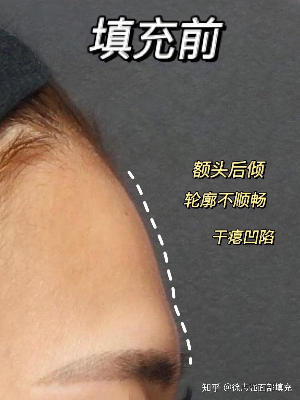 自体脂肪丰额头前后对比 - 知乎
