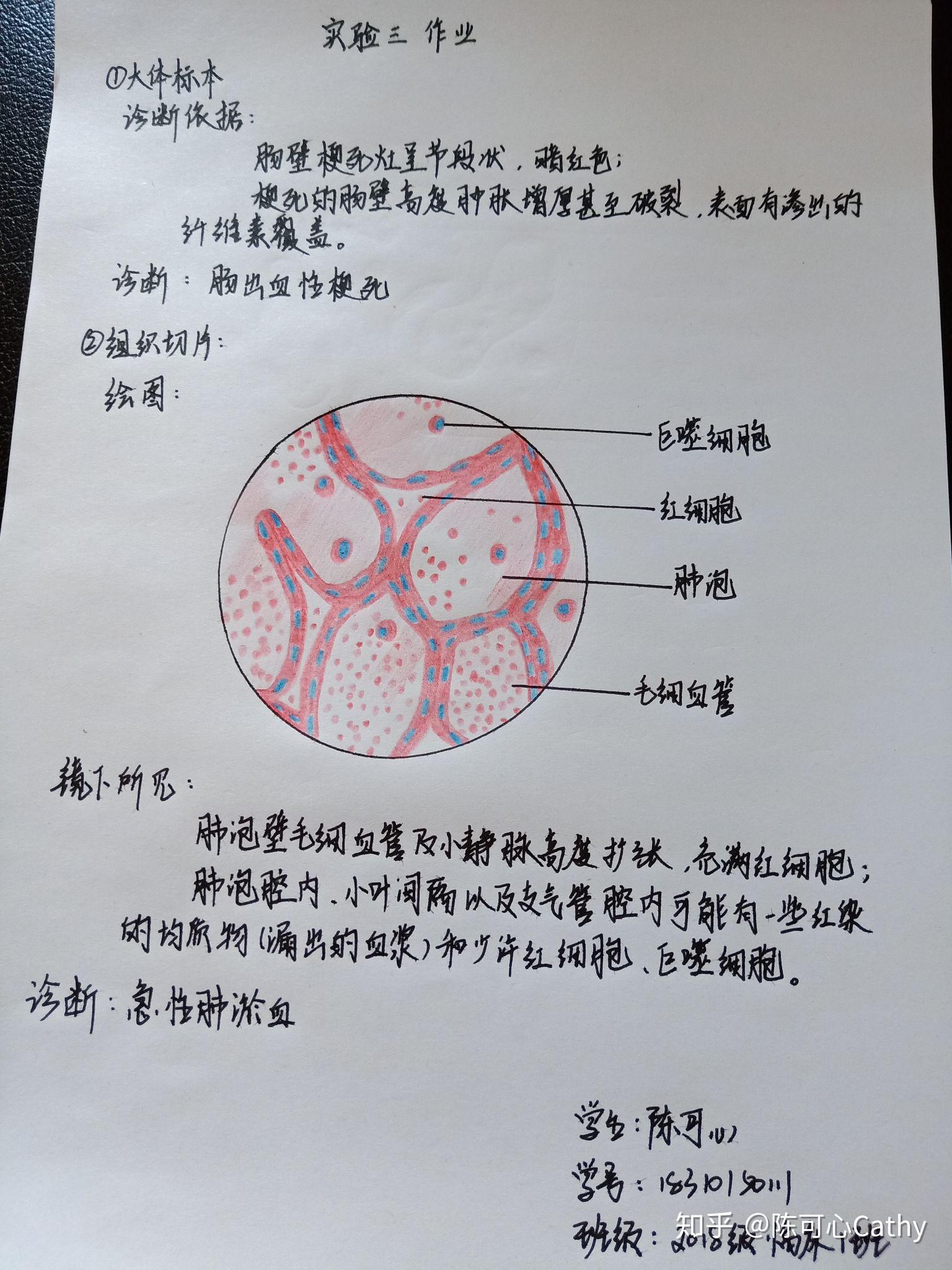 肺淤血实验报告手绘图图片