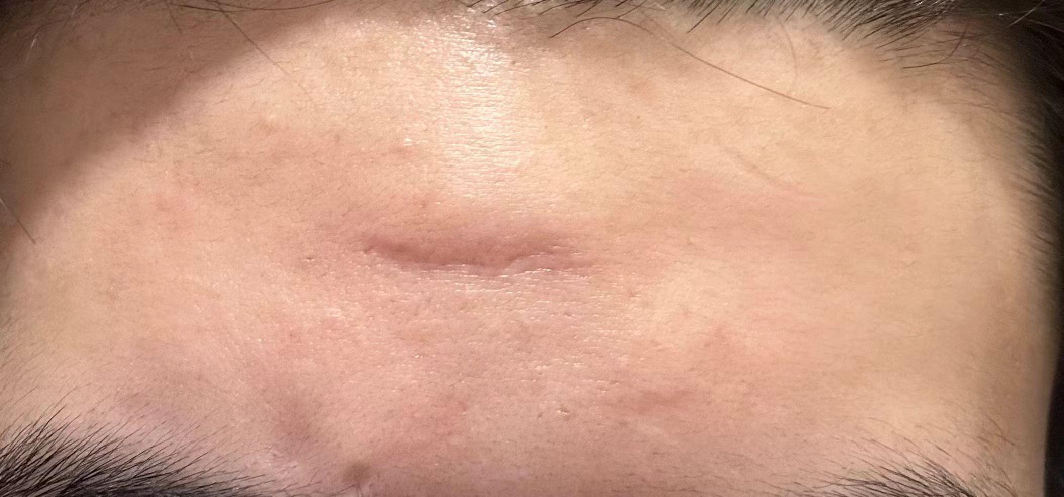 求助这种疤痕还可以修复吗