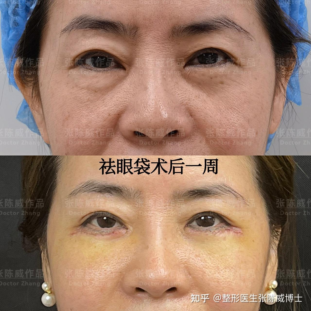 眼袋悬吊术后多久脸部表情正常