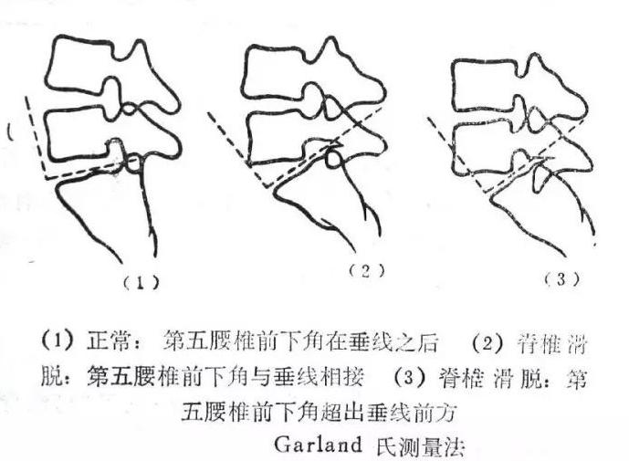 神内临床笔记50腰椎滑脱症