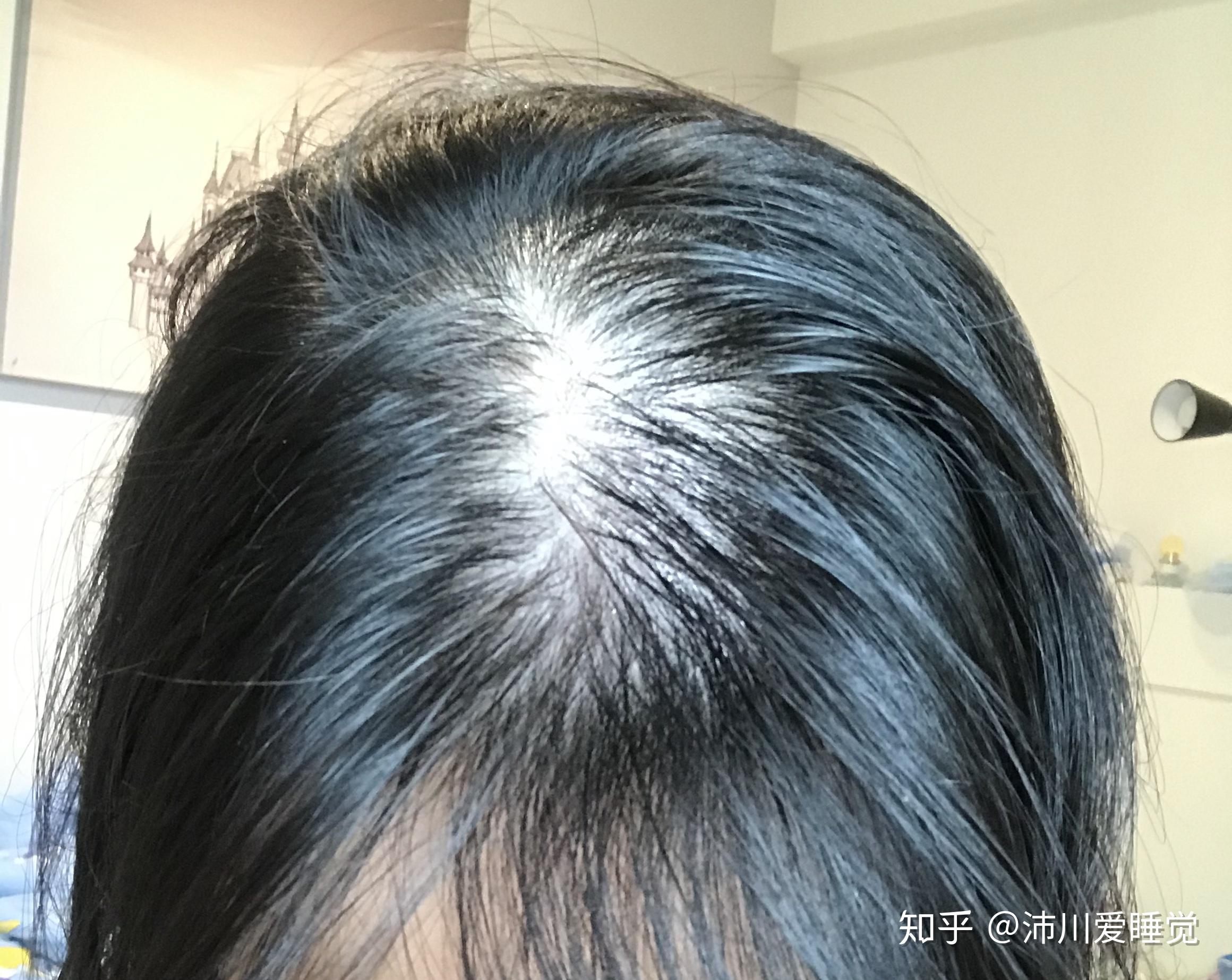 秃头3年女孩的米诺地尔酊使用记录