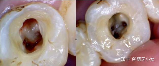 根管治疗有什么副作用吗
