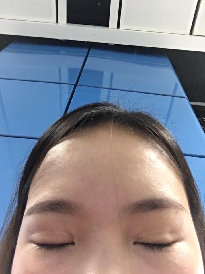 全切双眼皮两年半,闭眼疤痕凹陷,肉条,这样的好修复么,广州深圳有没有