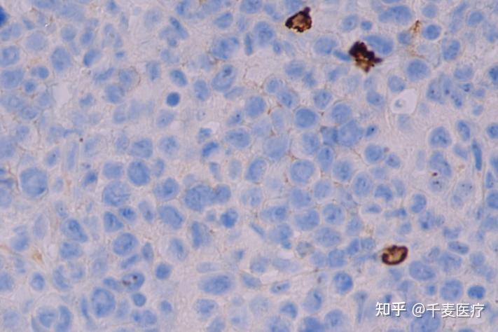 淋巴瘤病例实战分析:alk阴性间变大细胞淋巴瘤