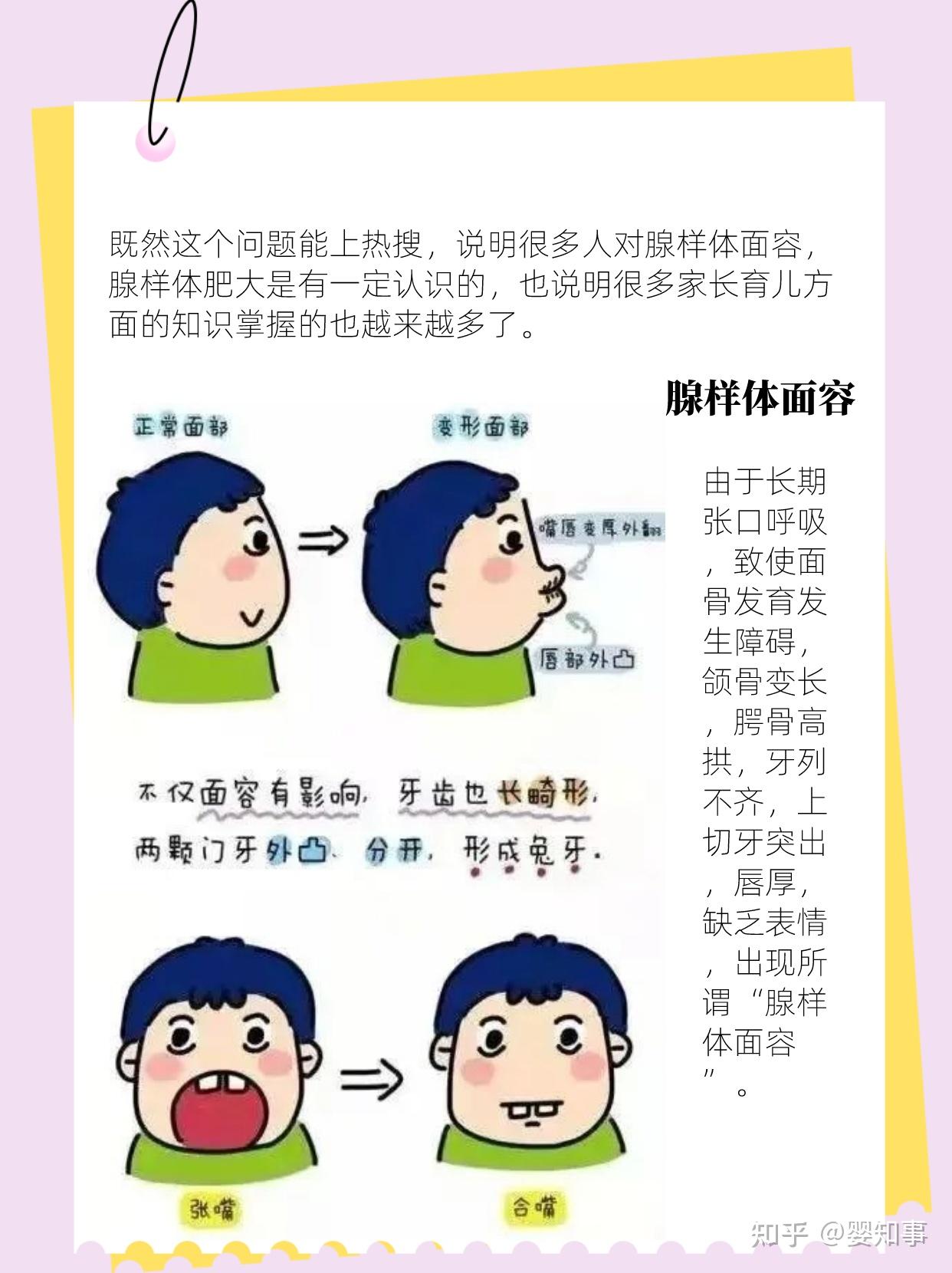 请问我这是否为腺样体面容?