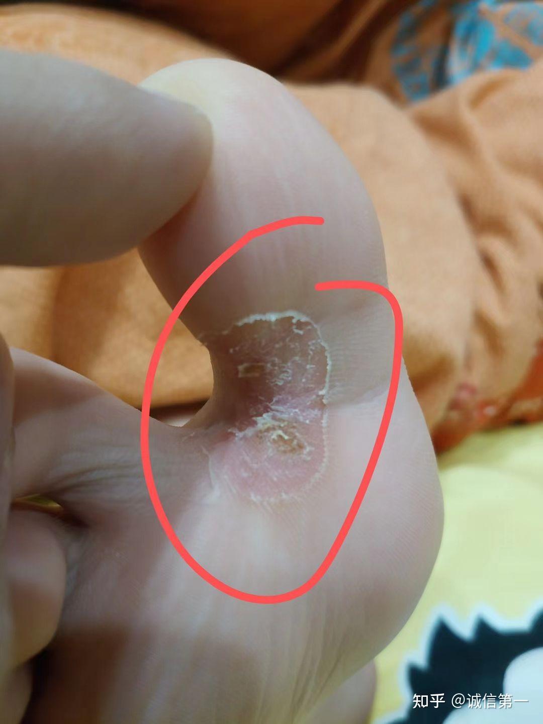 跎疣怎么形成的?