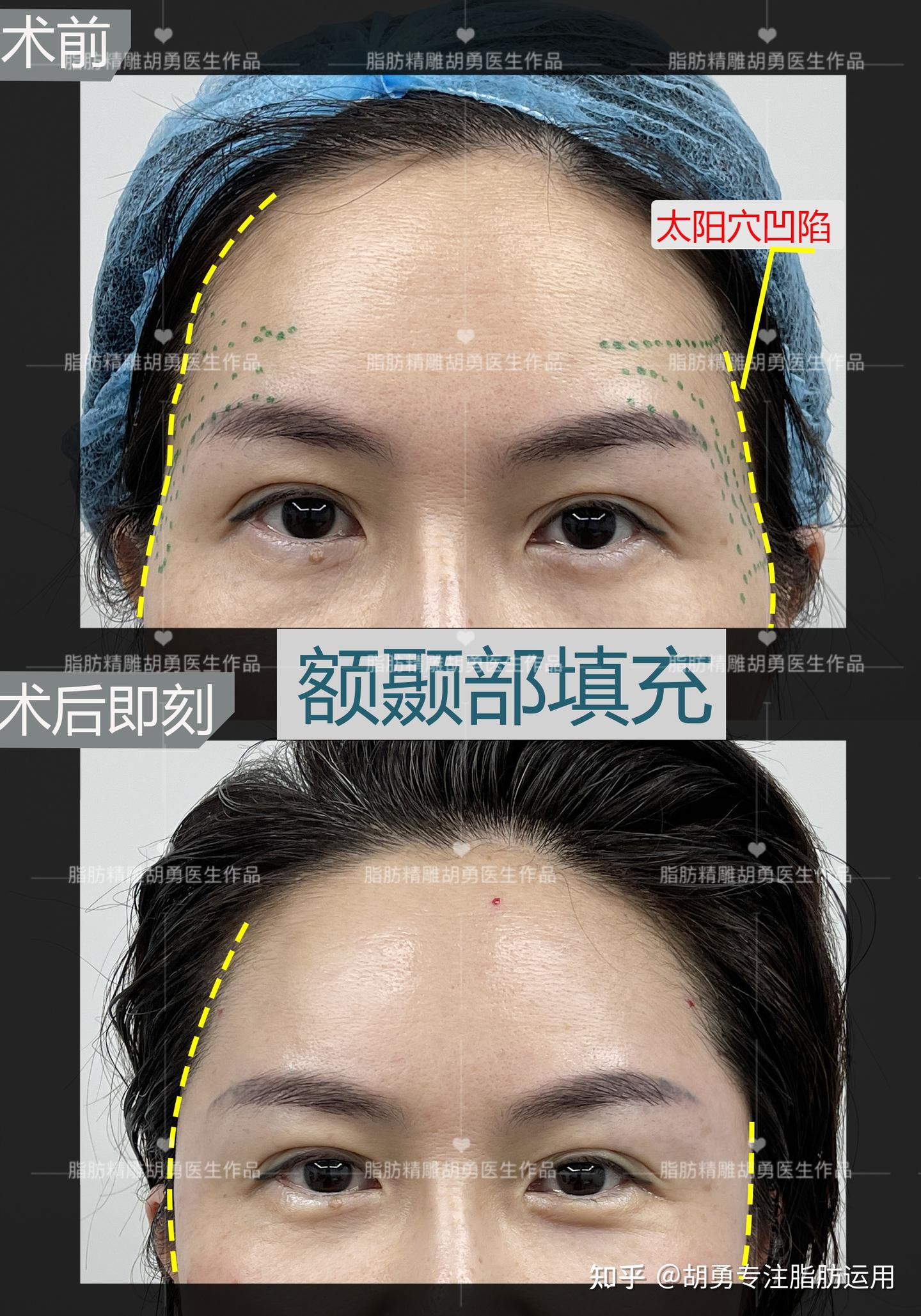 太阳穴、额颞部填充即刻对比 - 知乎