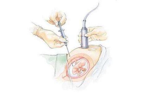 绒毛穿刺 - 知乎