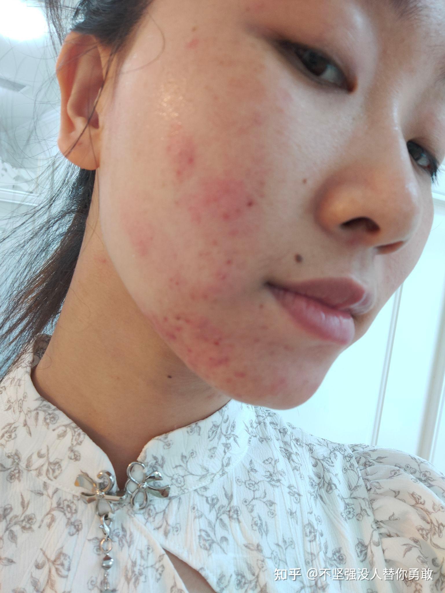 记录三甲医院刷酸全过程(持续更新) - 知乎