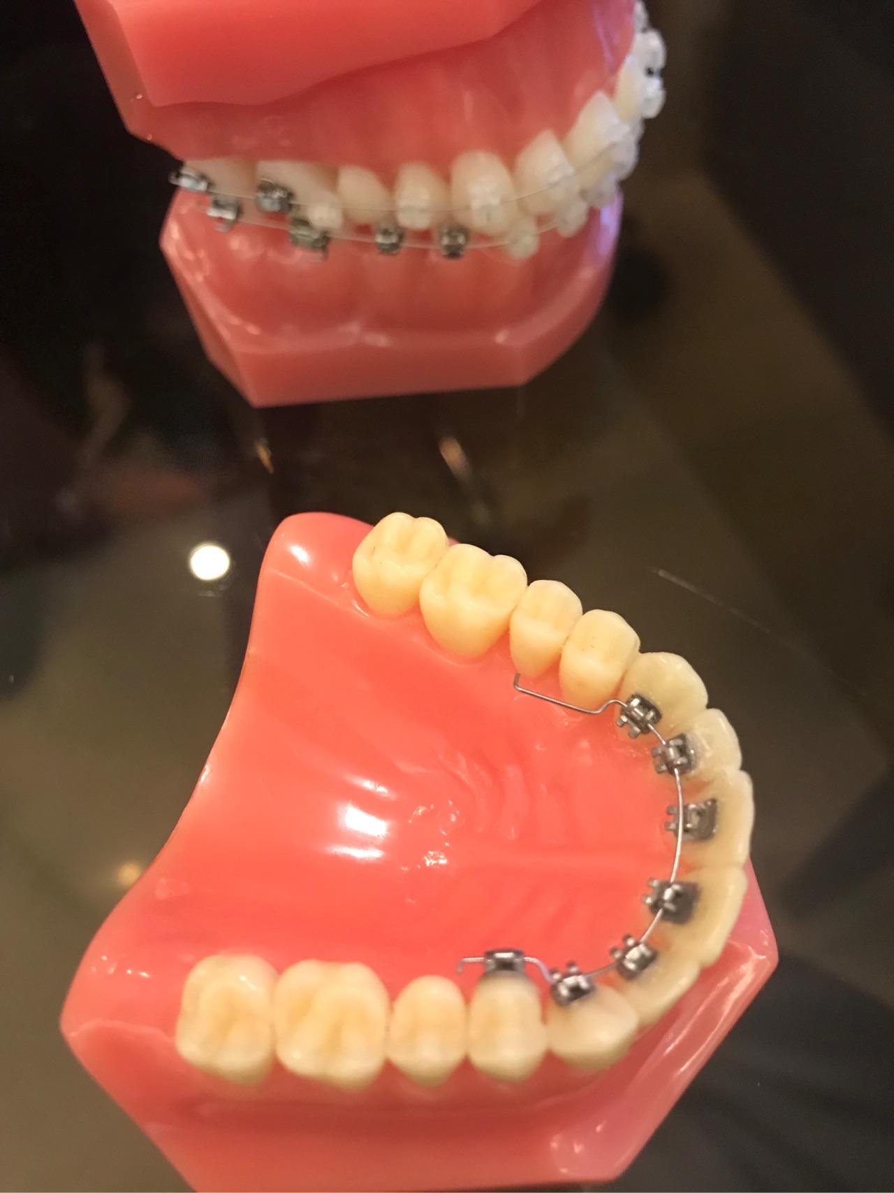 我的牙套修复路陶瓷环77舌侧77扩弓 - 知乎