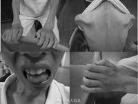 渐冻人症知识 - 知乎