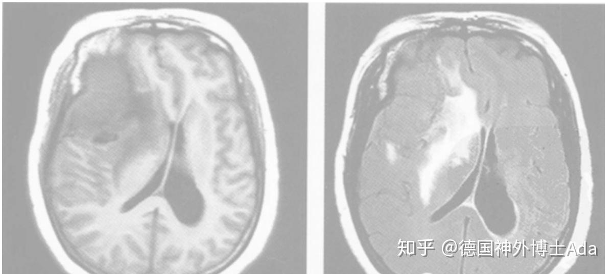 圖文詳解腦膜瘤的9種特異徵象