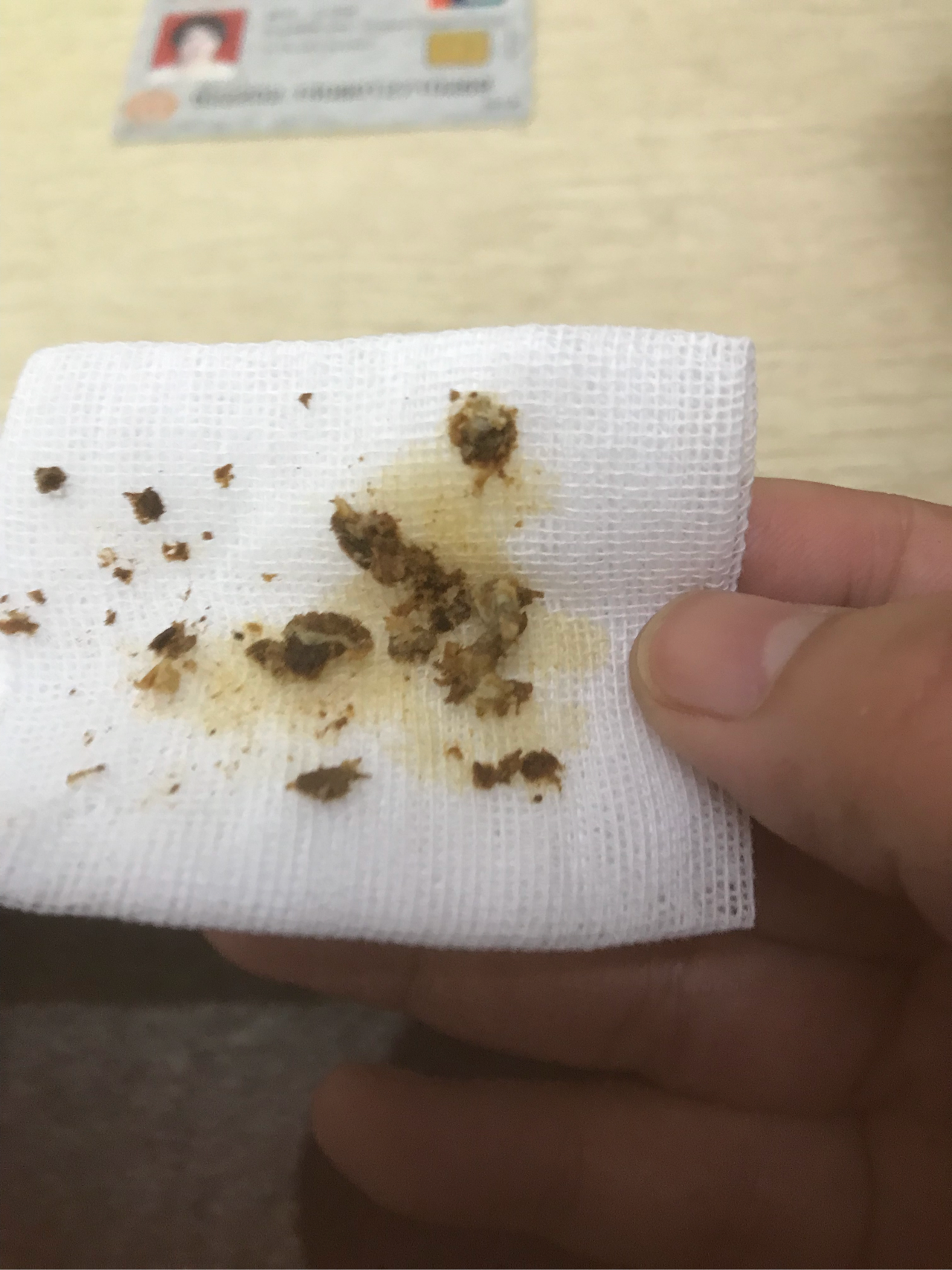 去医院挖耳屎是一种什么样的体验? - 知乎