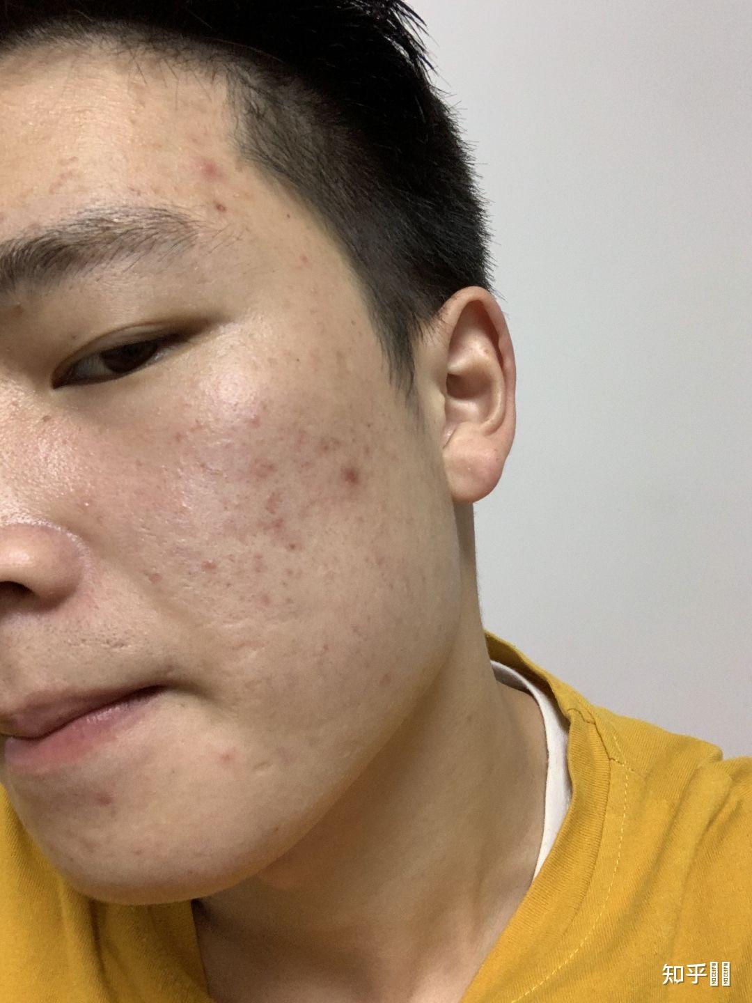 男士祛痘有哪些比较好的护肤品推荐