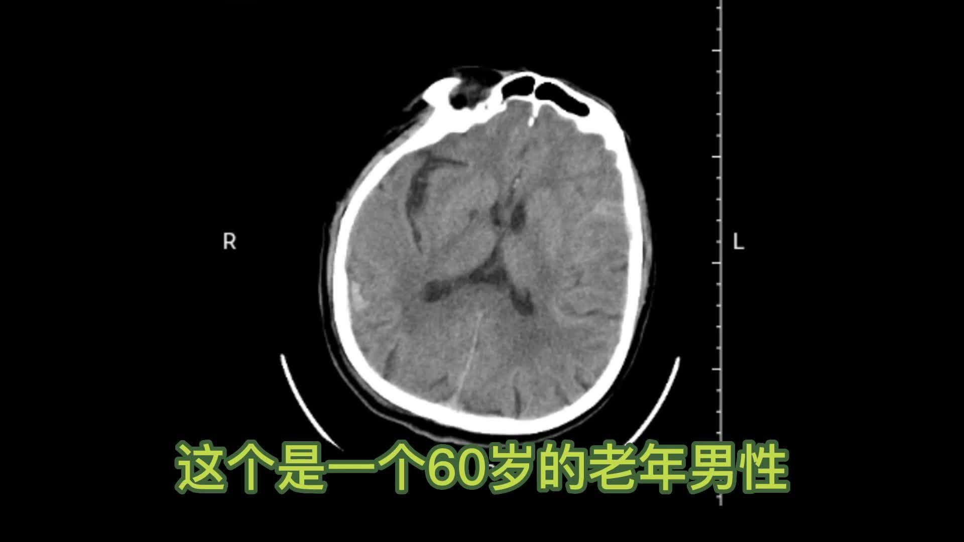是不是和你们一样呢? 多发脑挫裂伤走着出院 - 知乎