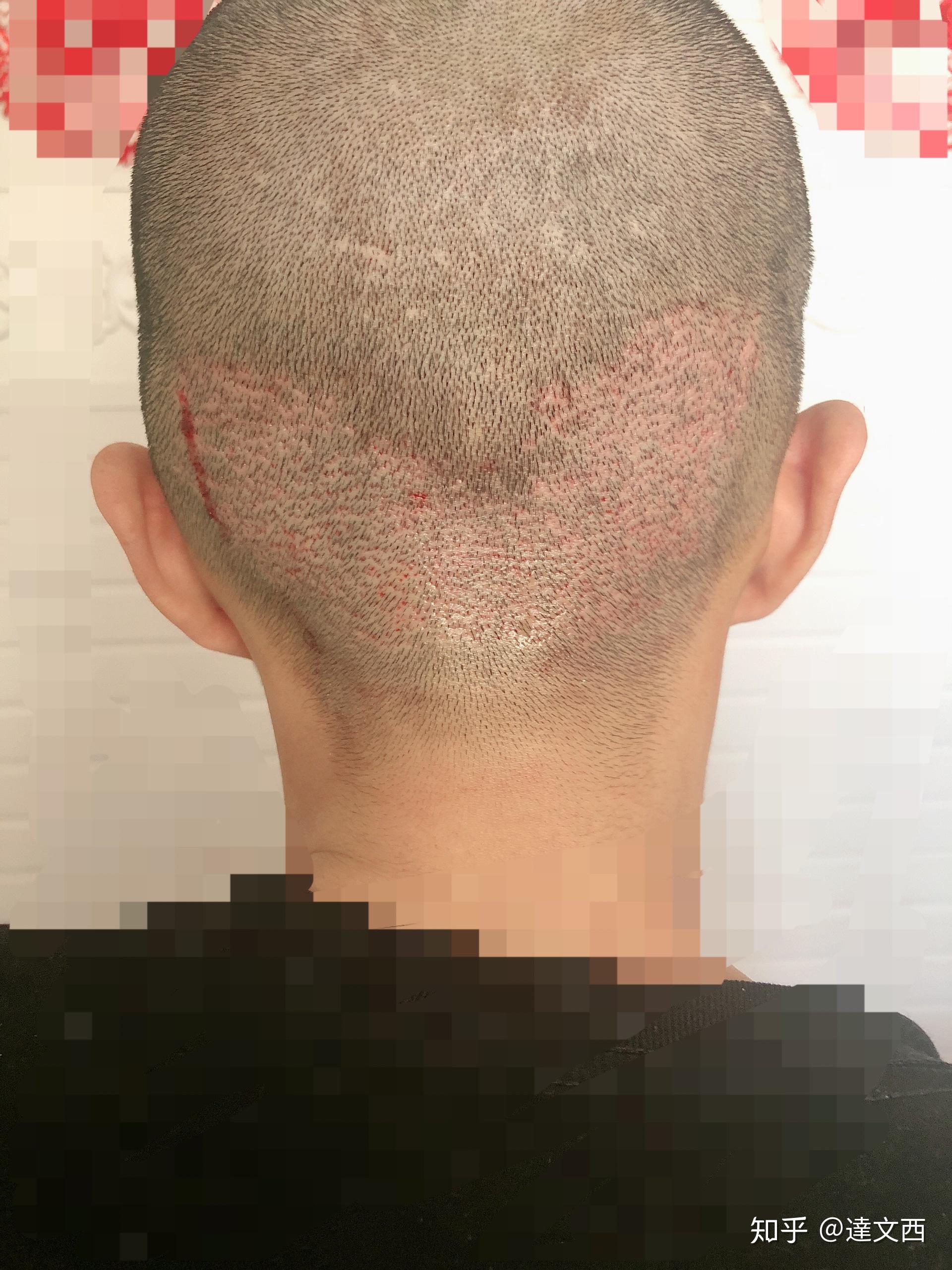 男士头顶稀疏 ，大面积加密植发，植发术后即刻效果 - 哔哩哔哩