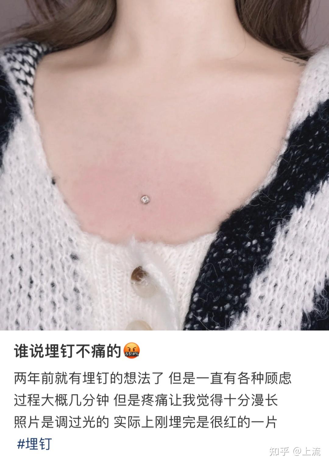 能分享下自己埋钉的经历吗? - 知乎