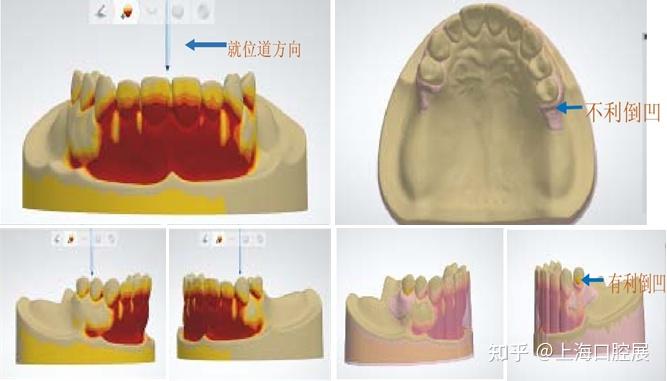 数字化技术在可摘局部义齿中的应用 - 知乎