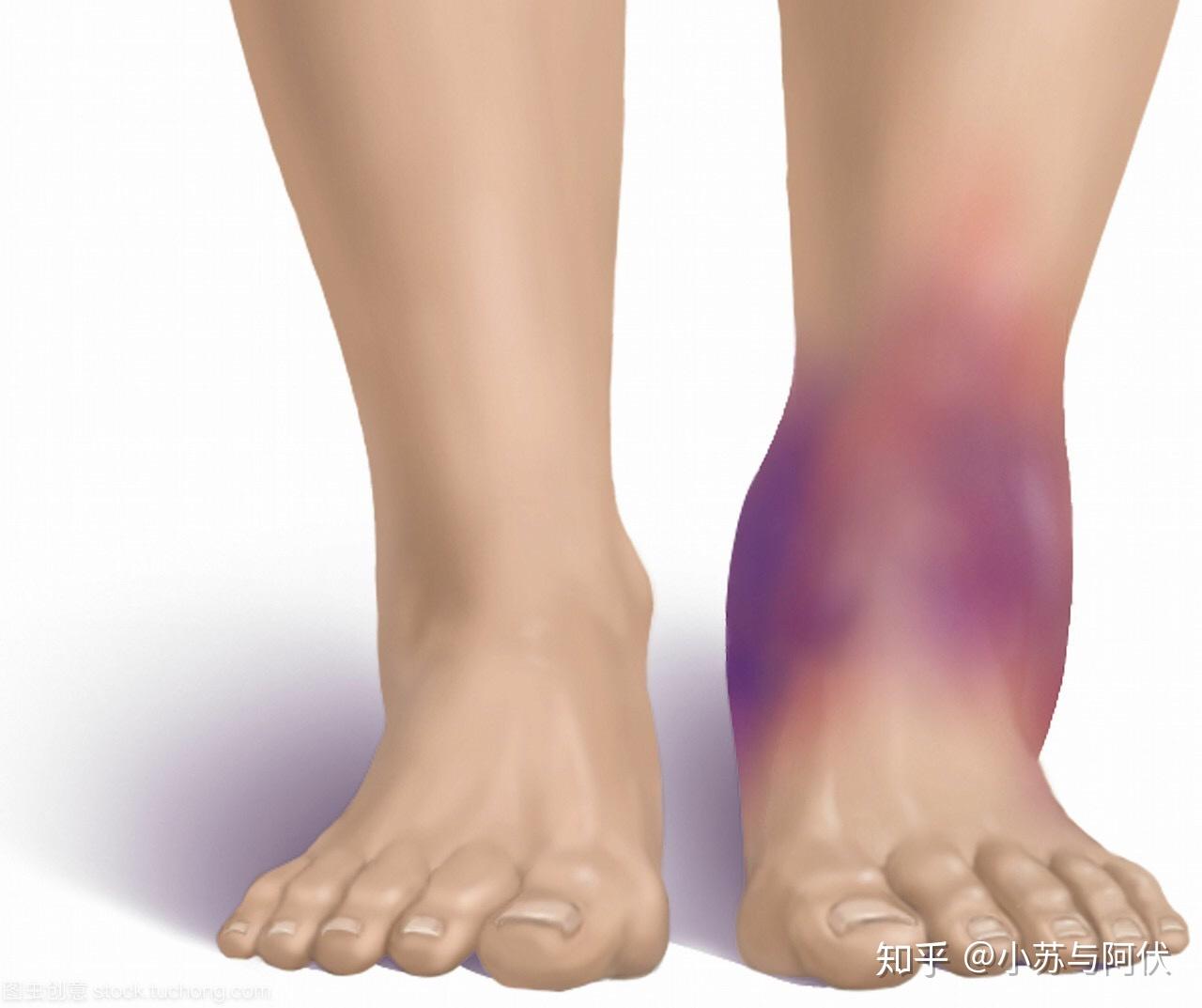 处理向踝关节扭伤自我康复方法