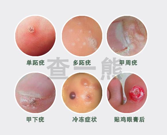 跖疣手册 跖疣你必须知道的那些事 知乎 跖疣手册 跖疣你必须知道的那些事 知乎