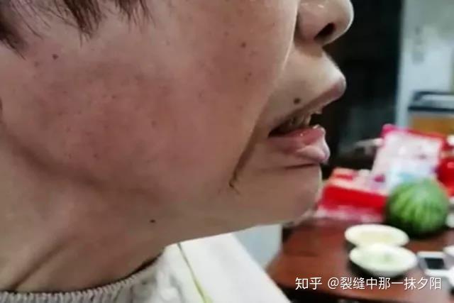 乐观的姜大姐来自北京市大兴区,10年前突然出现阵发性的张口困难,每隔