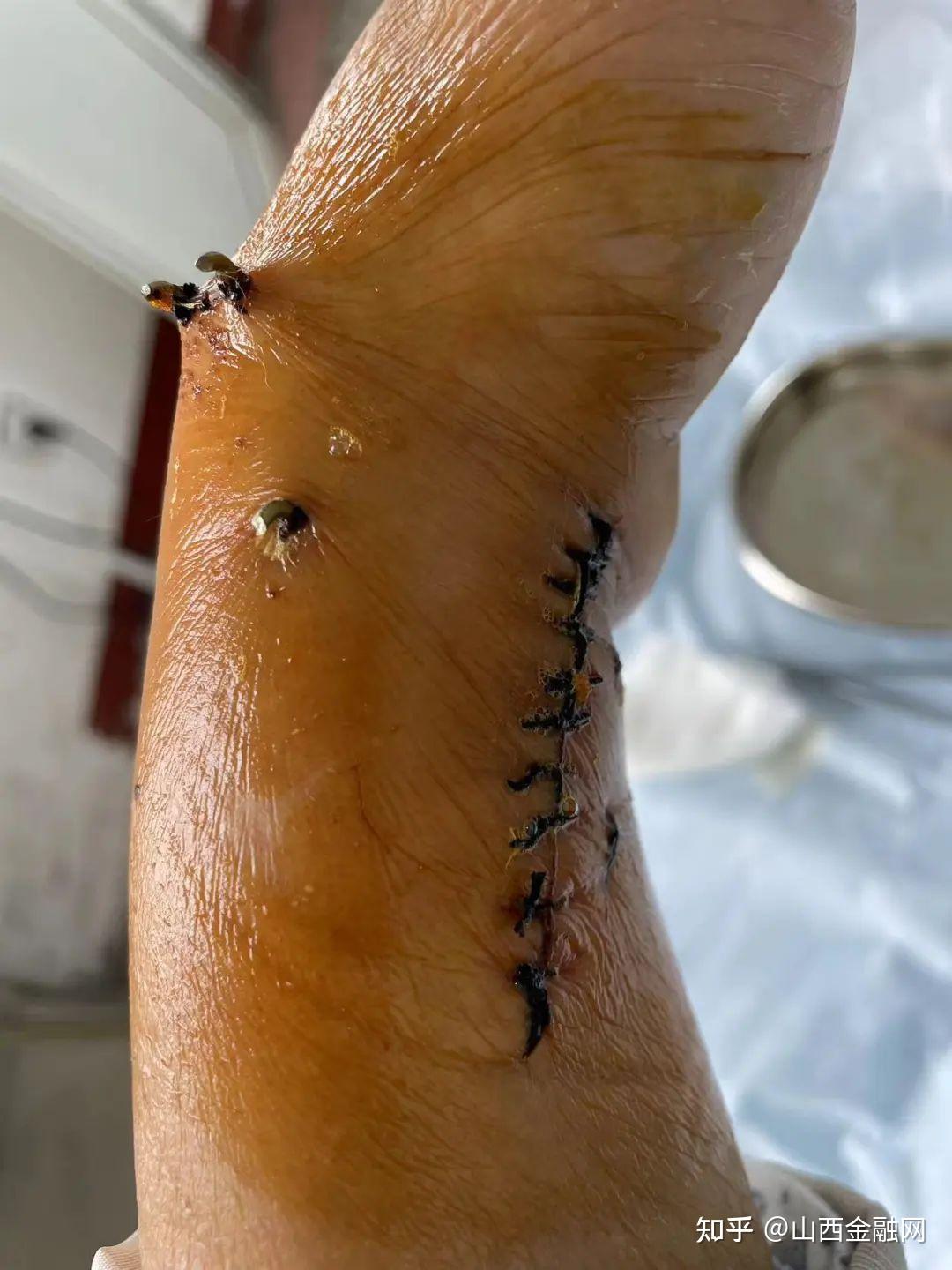 临汾女子被电动车刮倒在地手腕骨折肇事者不闻不问