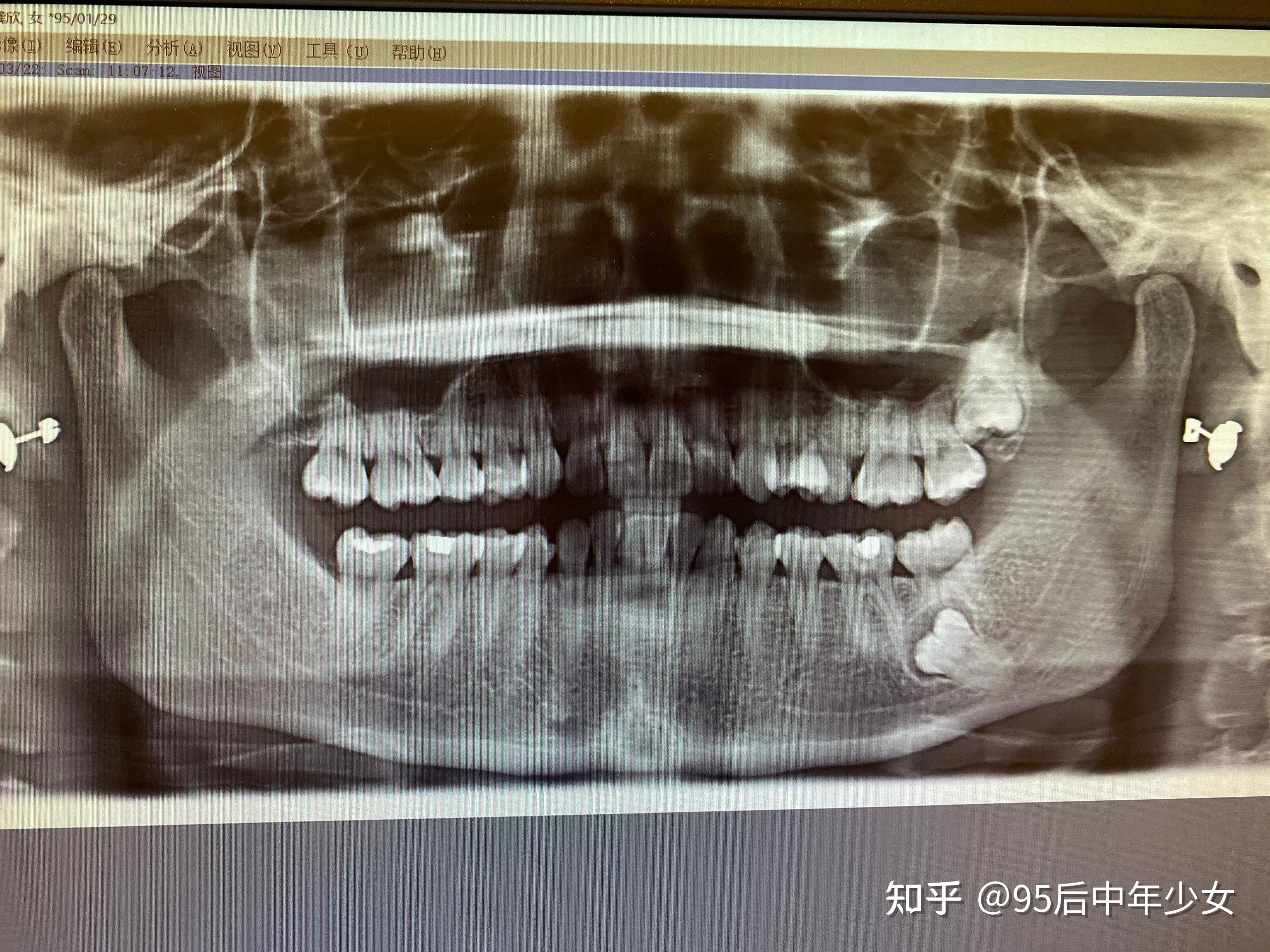 埋伏阻生智齿需要拔吗? - 知乎