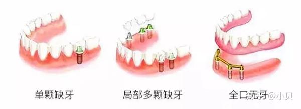 早知道有假牙也能矫正 我可能早就脱单了 内附种植牙科普 知乎