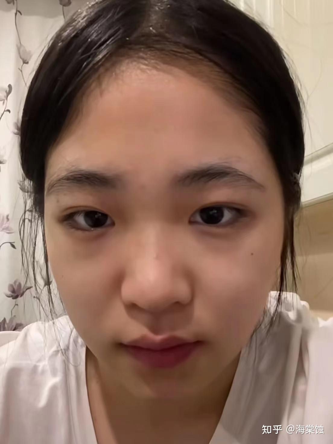 22岁,脸部状态差,浮肿虚胖,没钱做医美怎么办?