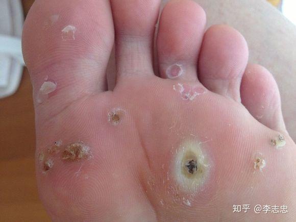 脚上长的是鸡眼跖疣还是老茧答案都在这