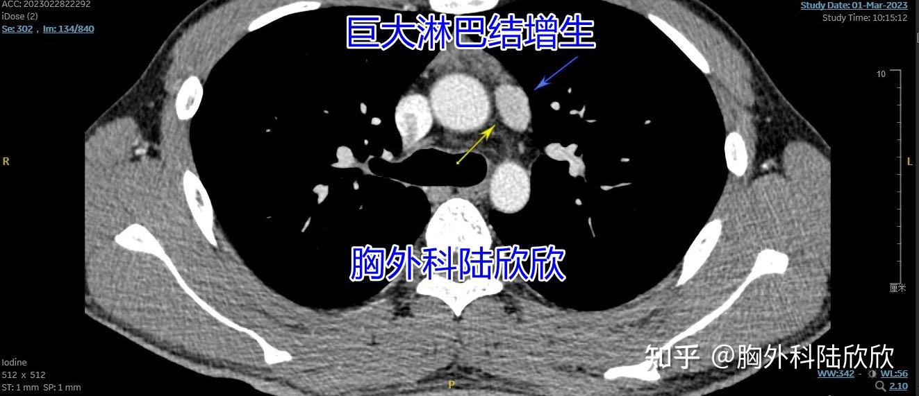 纵隔淋巴结增大图片