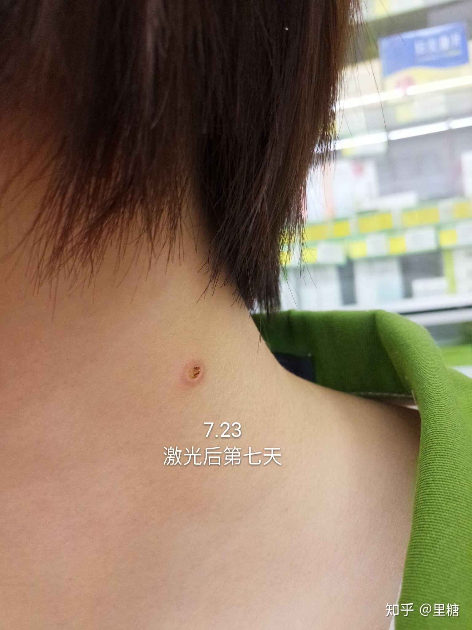 重庆手术祛痣 - 知乎