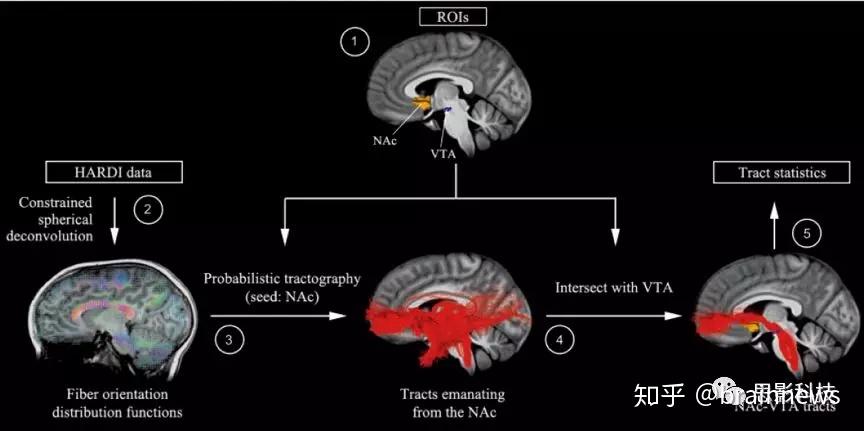 Brain: 中脑边缘奖赏通路损伤与自闭症儿童的社交障碍 - 知乎