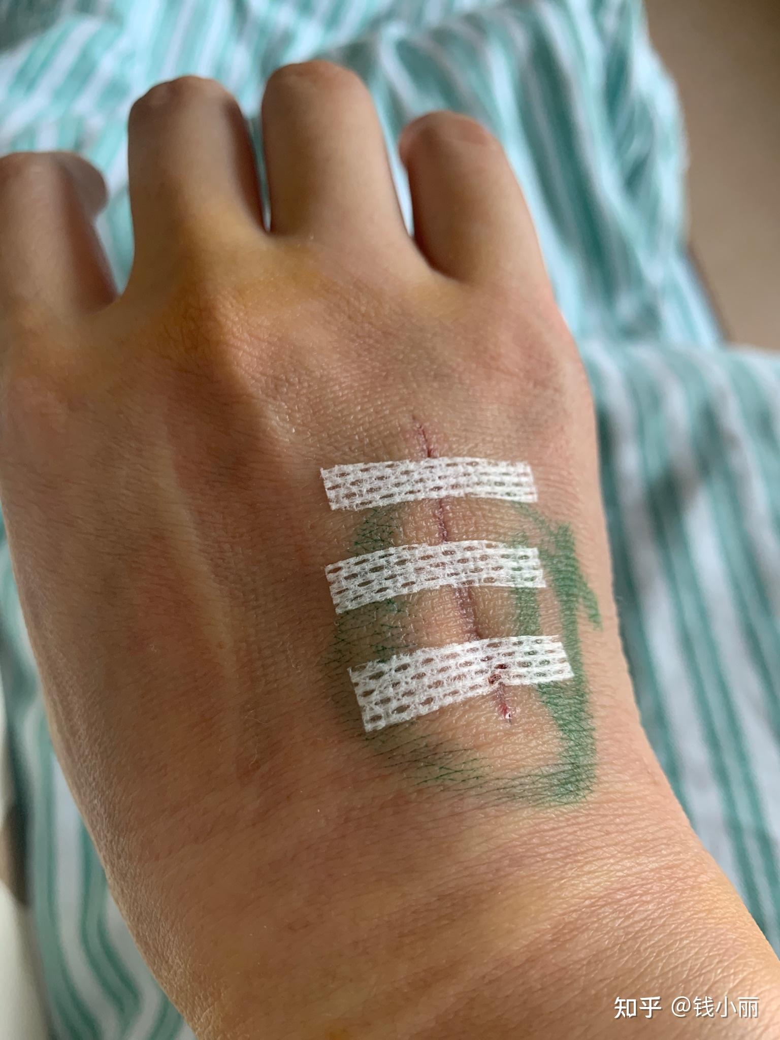 右手第四掌骨骨折记录