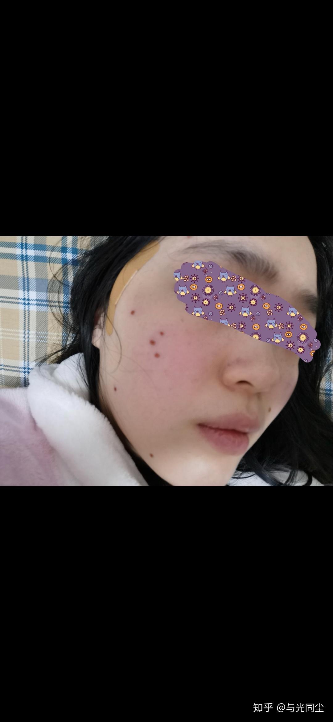 冬日除痣好时节点痣及术后全过程分享