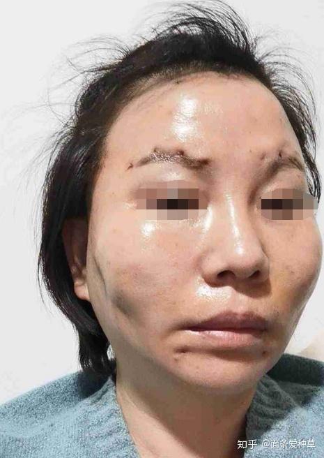 线雕埋线都有哪些后遗症