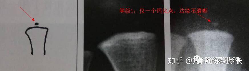 解析【中华05标准】骨龄检测—桡骨部分鉴定 - 重庆展望未来骨龄检测科研所