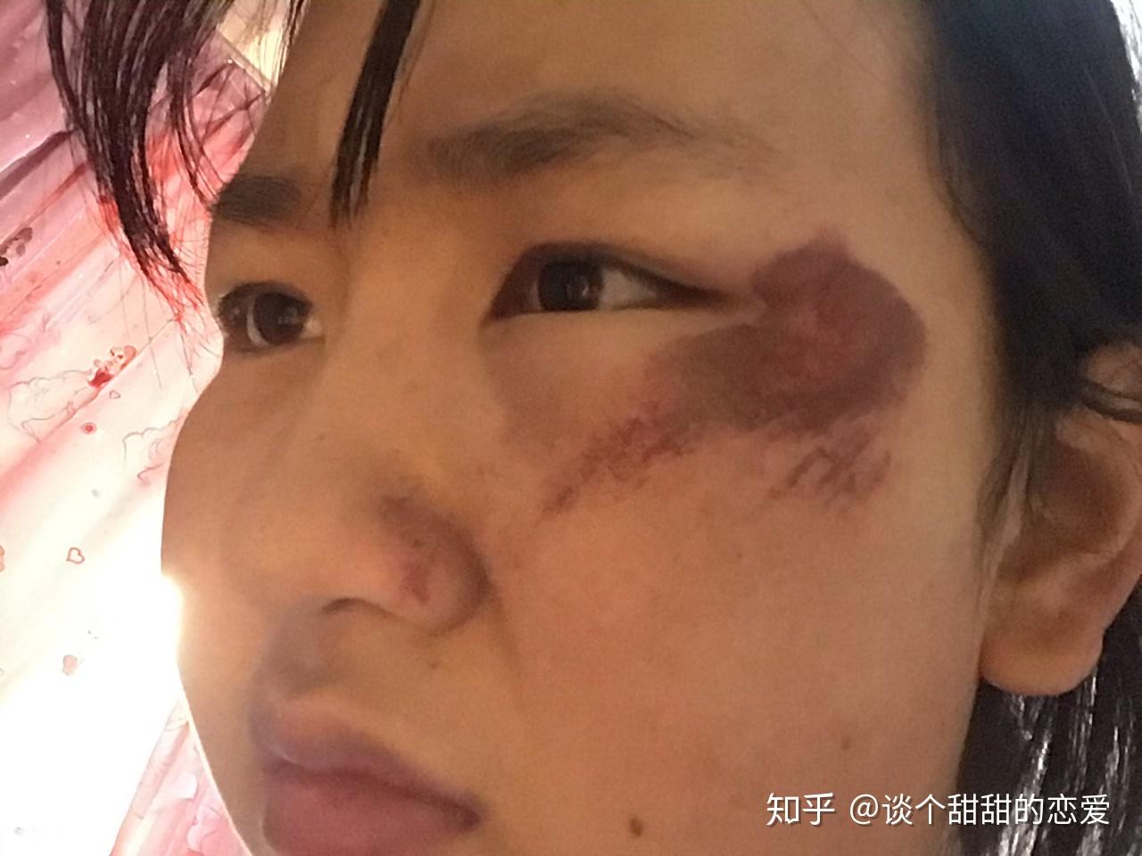 脸部擦伤如图,请问如何恢复? - 知乎